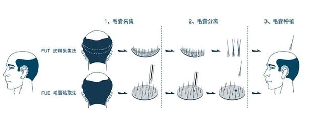 毛囊克隆植发技术最新进展