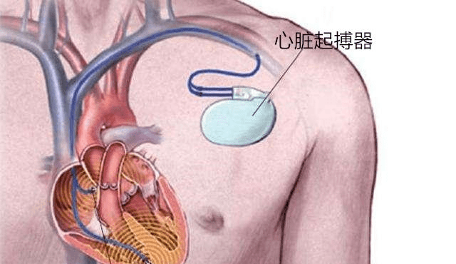 创新科技引领，全新一代无线心脏起搏器震撼登场